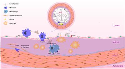 The cell origins of foam cell and lipid metabolism regulated by mechanical stress in atherosclerosis